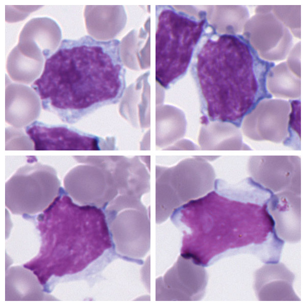 Lymphocyte (Neoplastic)
